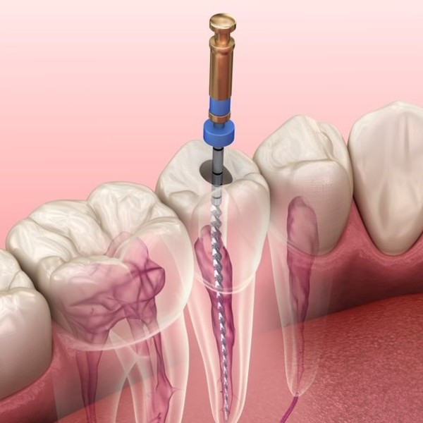 Root Canal